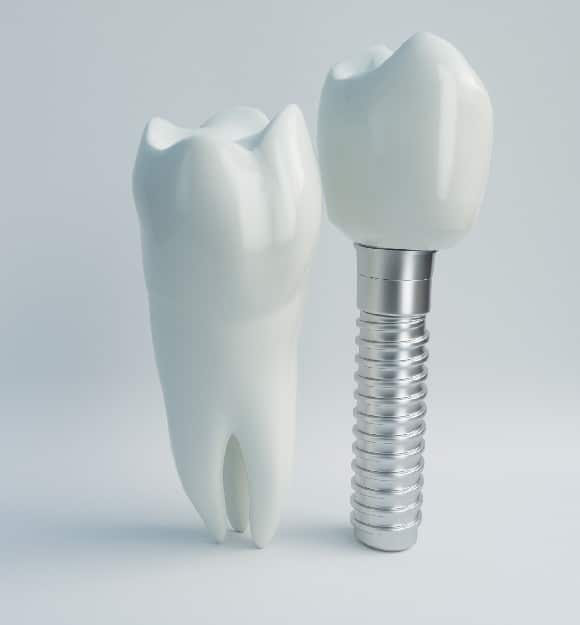 Incisionless Dental Implants – Rockefeller Cosmetic Dentistry