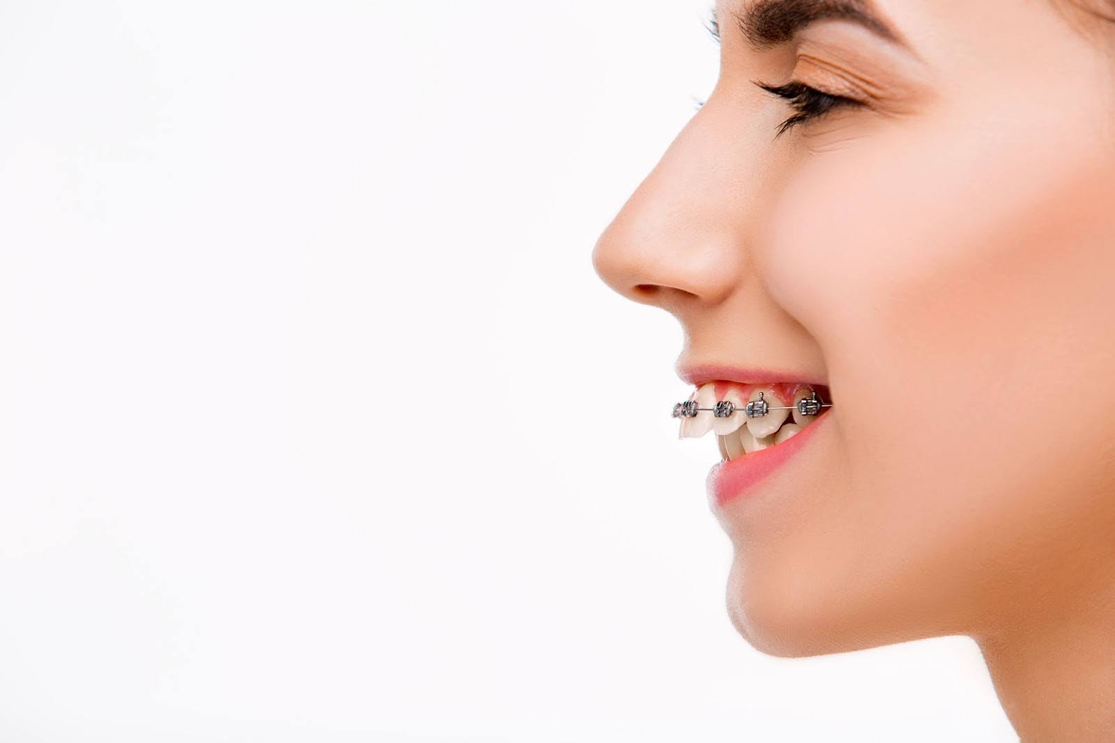Traditional Orthodontic Approaches to Overbites 
