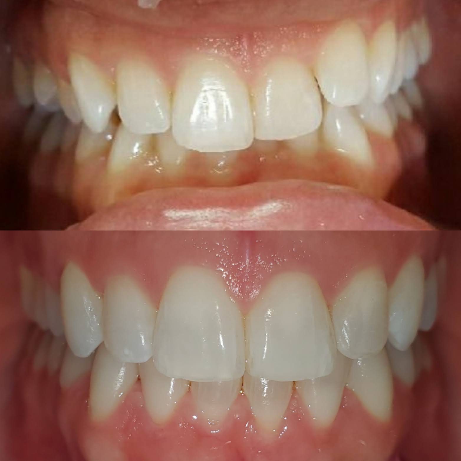 This is one of our Invisalign patients who sought treatment for their overbite
